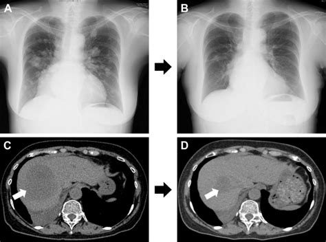 a representative patient with osimertinib treatment notes chest x ray