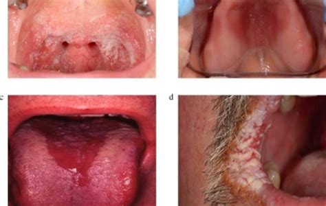 Symptoms Of Candida Findatopdoc