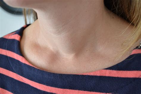 thyroid goiter  nodules       part