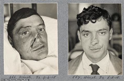 shocking pictures show   father  plastic surgery rebuilt world war  soldiers faces
