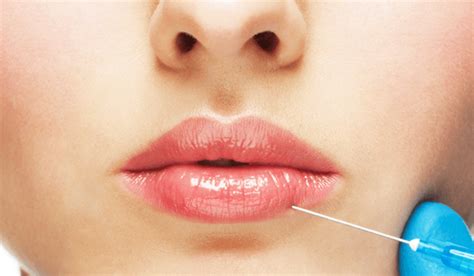 what is lip augmentation should one go for it
