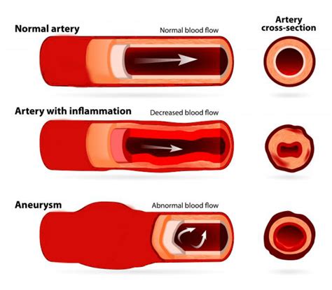 symptoms  brain aneurysm   find aneurysm  early days