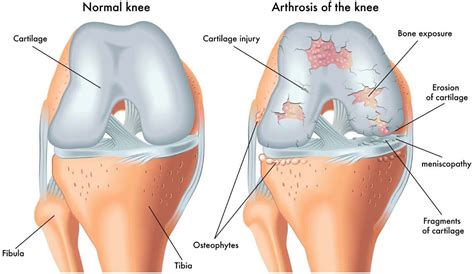 osteoarthritis local physio local physio