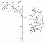 Catheters Coronary Patents Transradial Catheterization sketch template