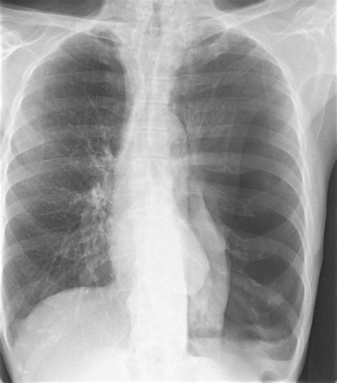 Chest X Ray With Pneumothorax