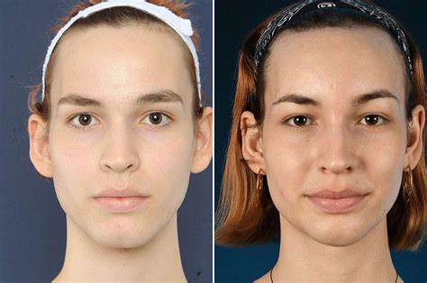 facial feminization surgery recontouring van het voorhoofd het