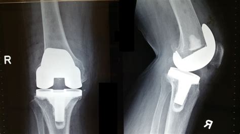 understanding knee replacement surgery bjios orthopaedics