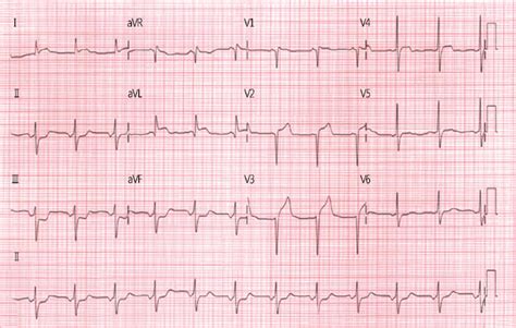 initial electrocardiogram findings   normal sinus rhythm