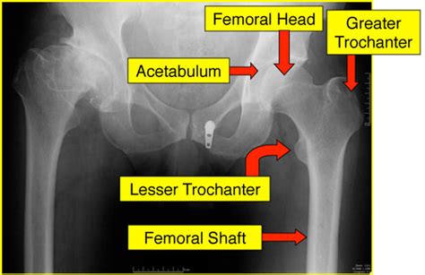 dr craig j della valle hip and knee surgeon hip resurfacing dr