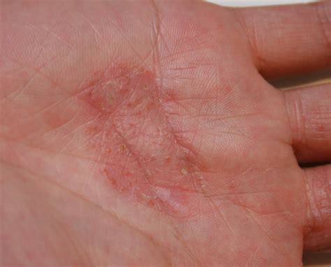 eczema  care   hands dr trevor erikson