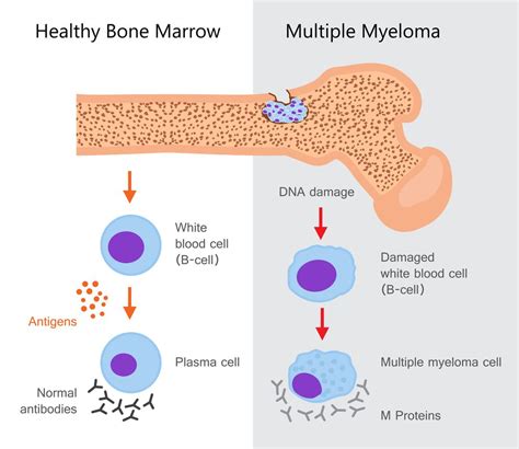 myeloma multiple overview  symptoms treatment illnesscom