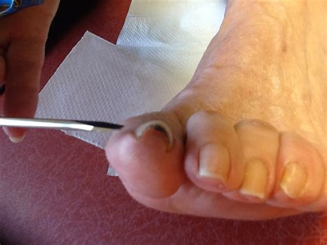 how do you fix curved toenails