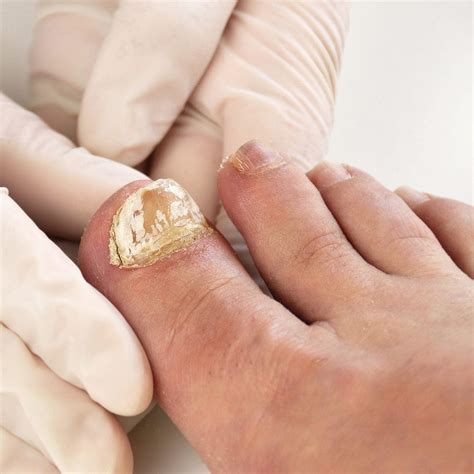 white toenail    fix  marietta foot doctor