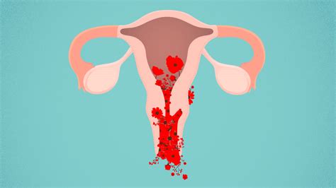 abnormal bleeding and gynecological cancer right as rain by uw medicine
