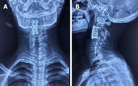 Anterior Cervical Corpectomy And Fusion Accf Best