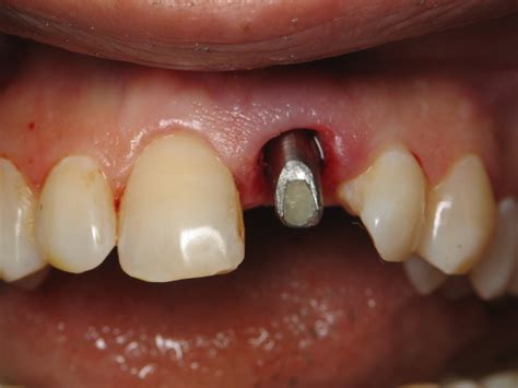 front tooth dental implant  difficult case ramsey