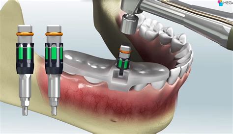 full digital dentistry   day implant dentistrycouk