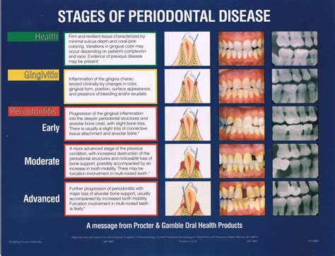 prevent periodontal disease community care college