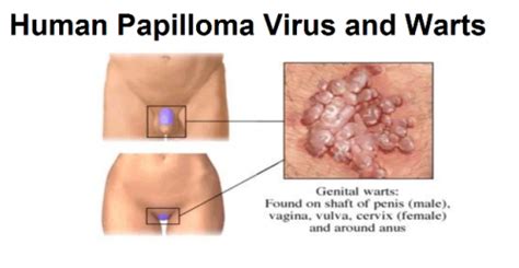 what is an hpv infection these are the symptoms causes and natural cures the science of eating