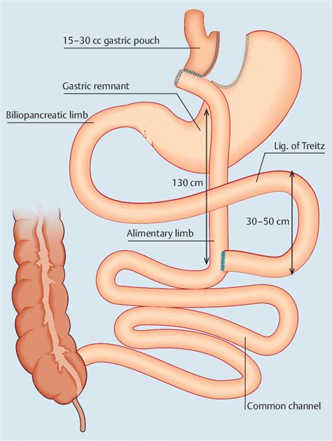 Roux En Y Gastric Bypass Configuration The Proximal