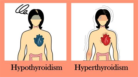 thyroid disease     difference   underactive