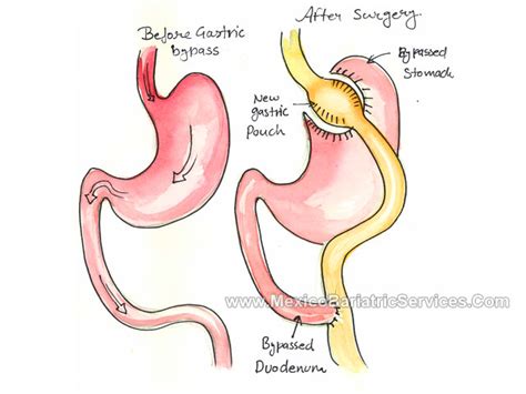 Gastric Bypass In Mexico Rny Mexico Bariatric Services