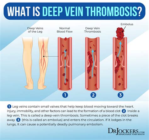 Deep Vein Thrombosis Causes Symptoms And Support Strategies