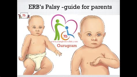 erbs palsy  detail  parents  bal