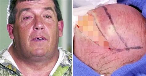 Man Dubbed ‘hunchback Of Notre Dame’ Has Huge Neck Cyst