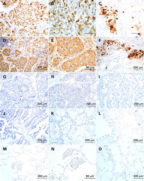 Selective Expression Of S100a7 In Lung Squamous Cell Carcinomas And