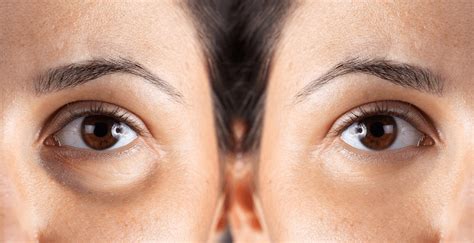 How Do You Get Bags Under Your Eyes 9 Causes And 10 Treat Ways Ulike