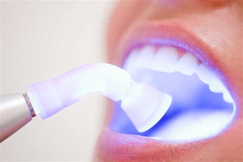 best teeth whitening methods everything you need to know