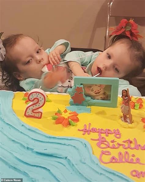 Mother Of Conjoined Twins 26 Says She Will Not Separate Them As They