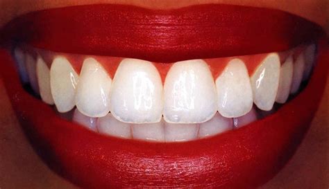 teeth whitening   professional dental set