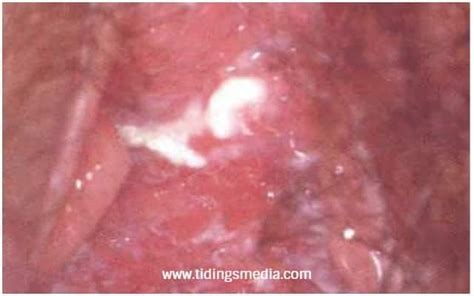 Itchy Vagina Vulva Labia Worse At Night Causes Std