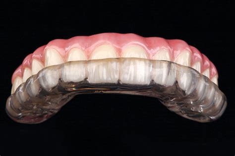 custom fit  store bought occlusal guard