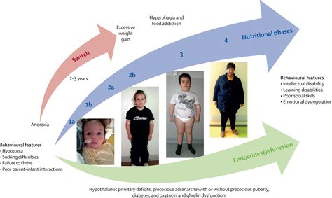 Endocrine Disorders In Prader Willi Syndrome A Model To Understand And