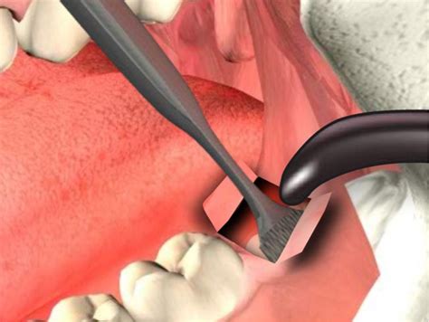 germectomy on wisdom teeth news dentagama