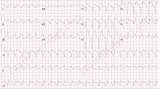 Ecg Tachycardia Ventricular Findings Example sketch template