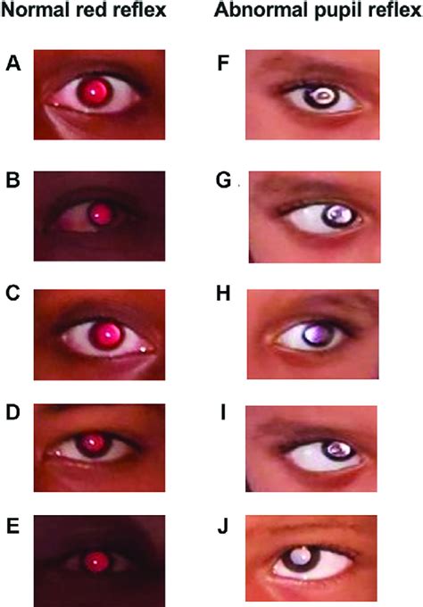 sample images  aee normal red reflex  fej abnormal pupil
