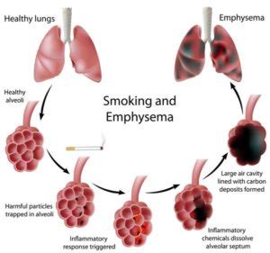 quitting smoking   clean lungs  achieve perfect health