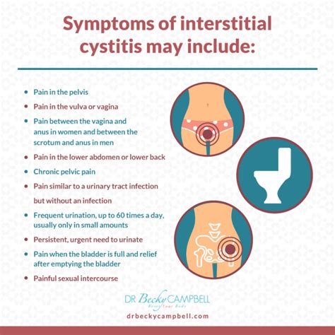 interstitial cystitis and the histamine connection dr becky campbell