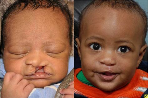 cleft lip  cleft palate johns hopkins facial plastic