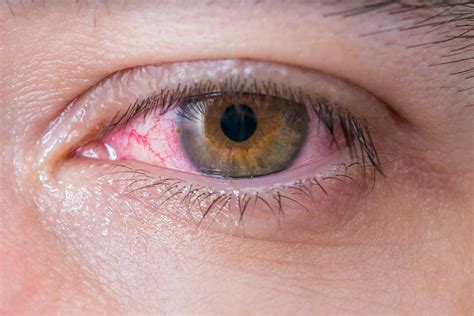 red eyes common symptoms   treatment