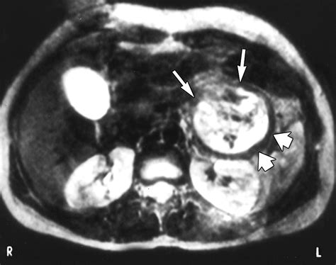 Mr Imaging Features Of Solid Pseudopapillary Tumor Of The Pancreas In