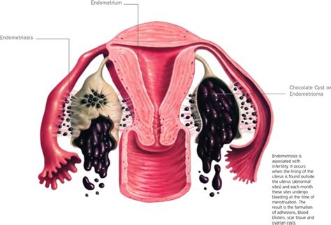 Causes Endometriosis Fertility And Ivf Coastal Ivf Sunshine Coast