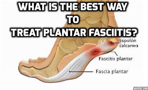 Revealing Here What Is The Best Way To Treat Plantar Fasciitis