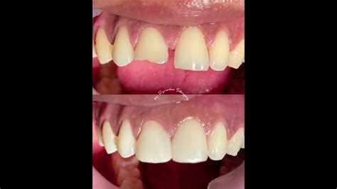 veneer gigi depan anterior merapatkan gigi berjarak veneers