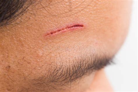 close   painful wound  forehead  deep cut stock photo image