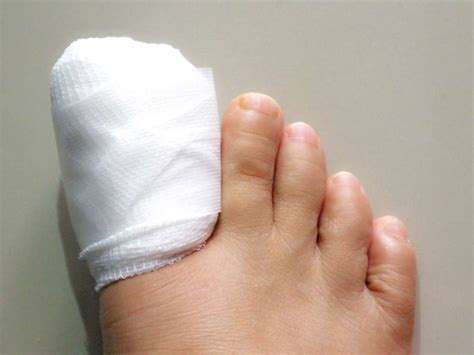 Surgery For Ingrown Toenails Procedure Recovery And Risks
